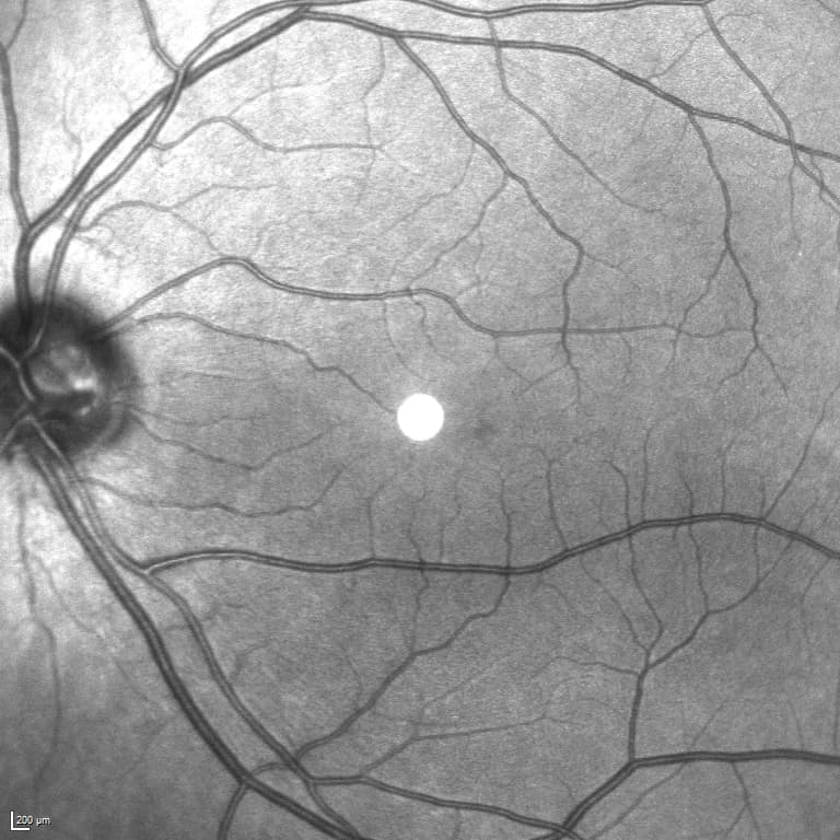 OCT scan with infrared fundus overlay showing cross-sectional and en face views