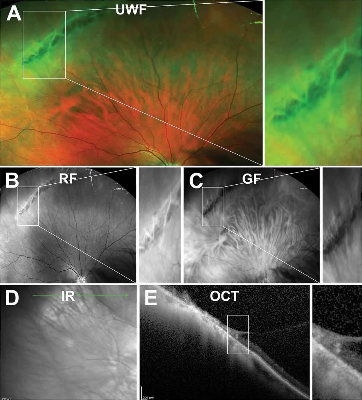 Multimodal retinal imaging figure combining widefield, infrared and OCT views