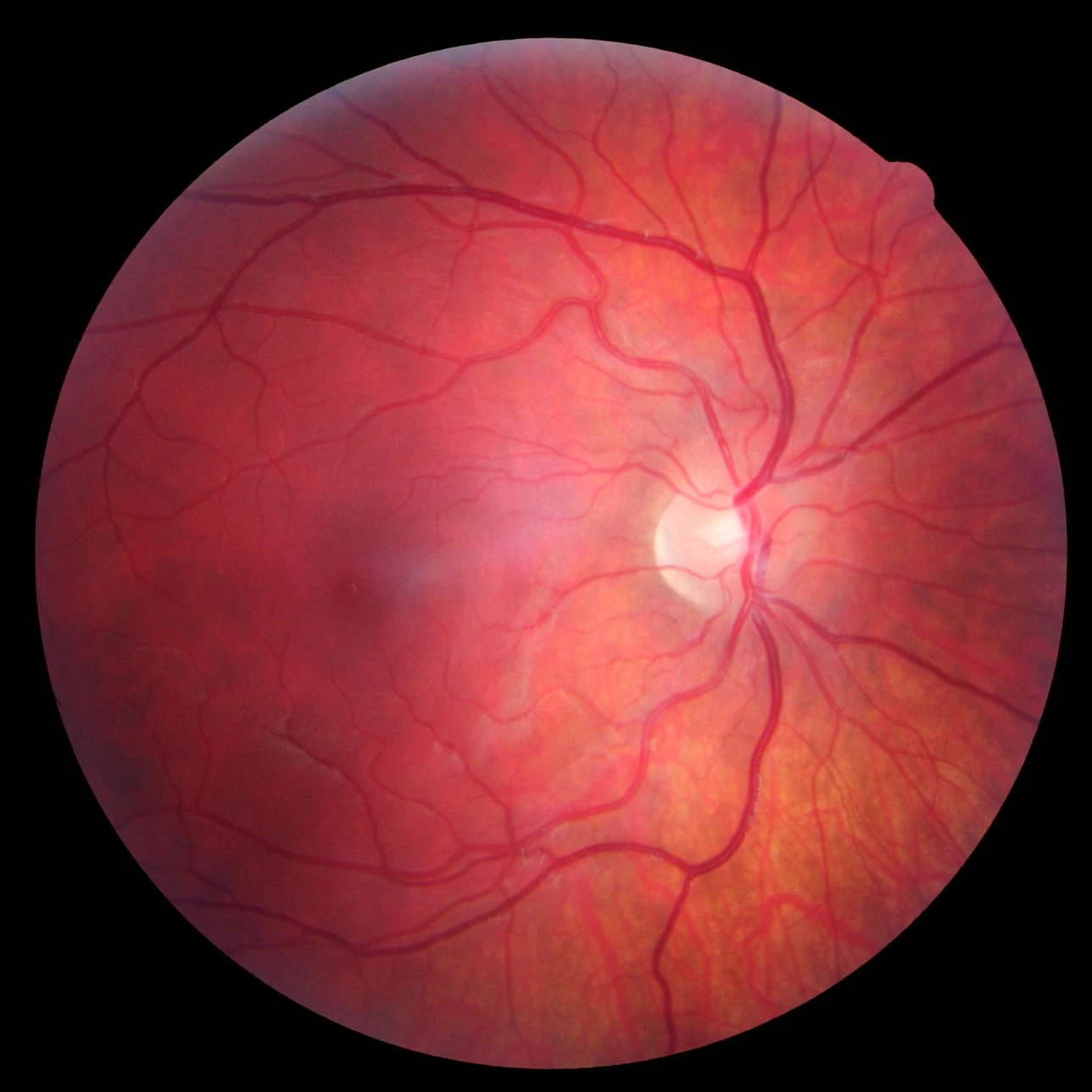 Fundus photograph of right eye showing retinal vasculature and optic nerve