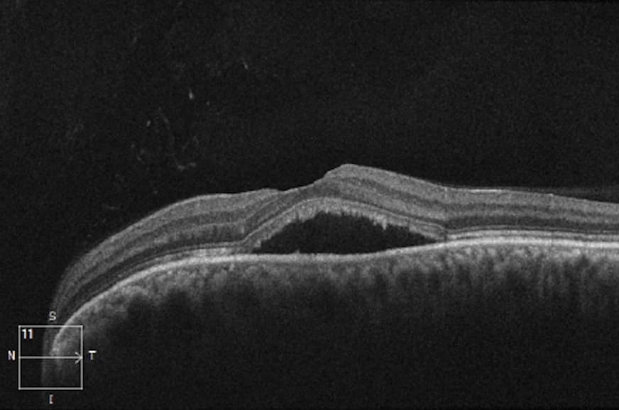 Retinal OCT cross-section showing altered anatomy that can challenge automated segmentation